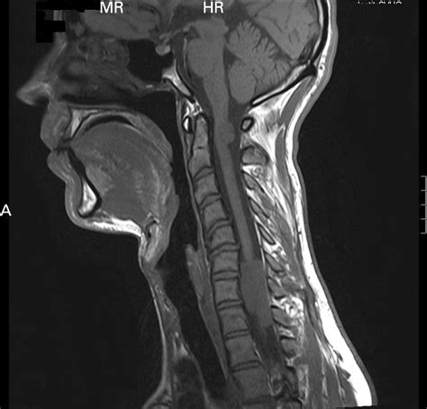 An Unusual Cause Of Collapse And Neck Pain Emergency Medicine Journal