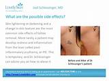 Side Effects Of Tattoo Removal By Laser