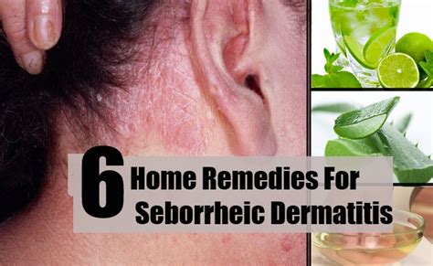 6 Home Remedies For Seborrheic Dermatitis Natural Treatments And Cure