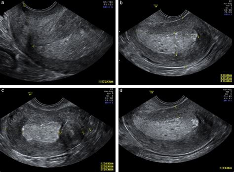 Uterus Cancer Ultrasound