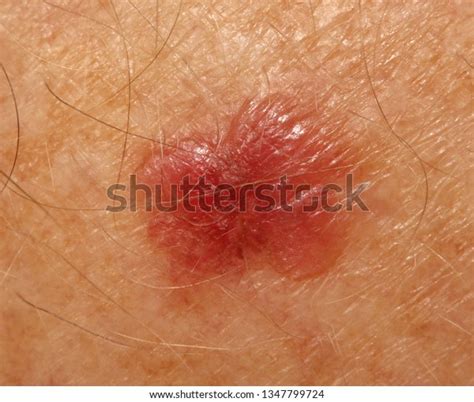 Case Lichen Planuslike Keratosis Lichenoid Keratosis Foto De Stock