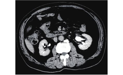 Enhanced Computed Tomography Scan Shows The Left Kidney Hydronephrosis