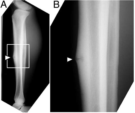 Lateral Radiograph Of Anterior Mid Tibia Stress Fracture A High