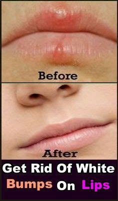 Jun 05, 2020 · some anecdotal evidence suggests that certain home remedies may help get rid of pimples on the lips. Home Remedies To Get Rid Of White Bumps On Lips - Beauty 4 ...