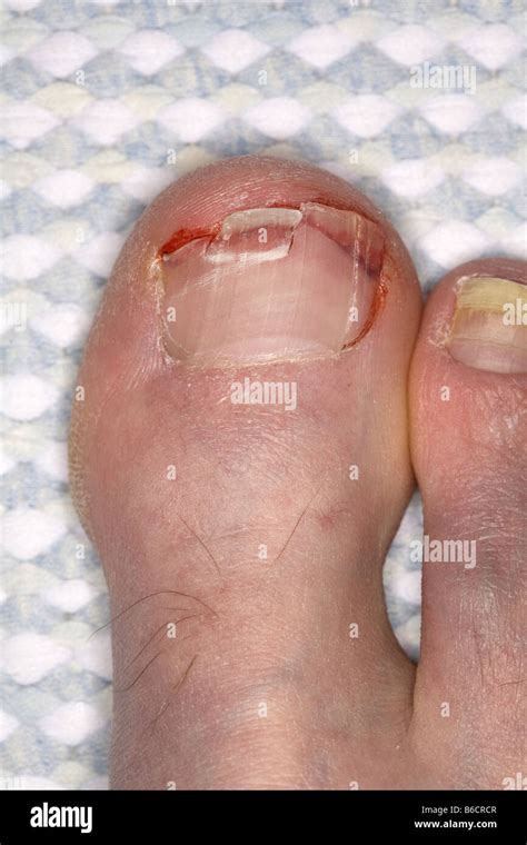 Bruised Toe High Resolution Stock Photography And Images Alamy