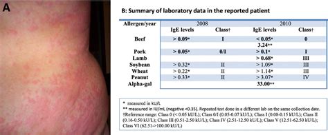 Anaphylactic Reactions To Oligosaccharides In Red Meat A Syndrome In