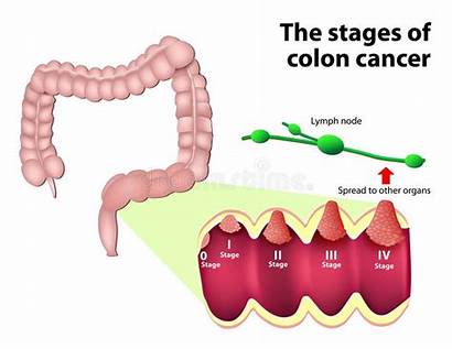 Cancer Colorectal Stages Stage Bowel Tumor Malignant