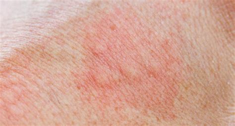 Identifying Skin Rashes In Adults 042022