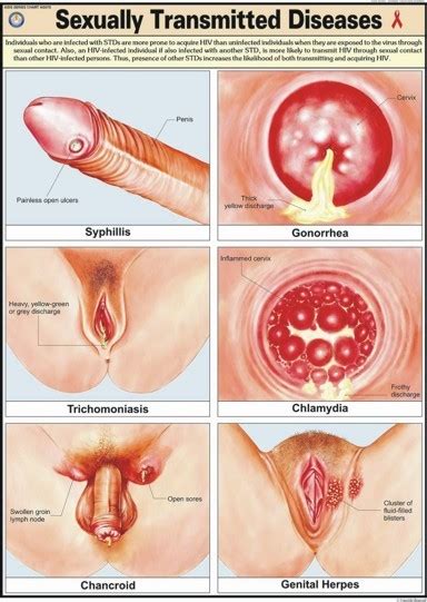 Sexually Transmitted Diseases Chart Manufacturer Supplier Free