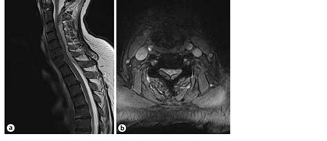 Mri Cervical Spine T2 Sagittal A And Axial B Views Demonstrating A