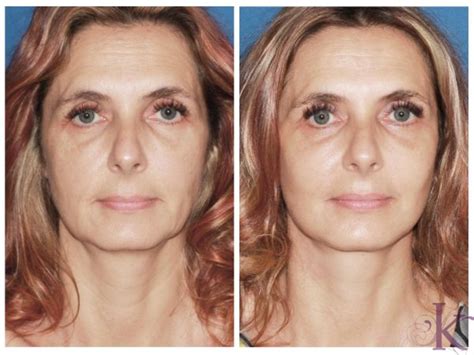 Mini Facelift Before And After Photo Gallery New York Ny Konstantin Vasyukevich Md