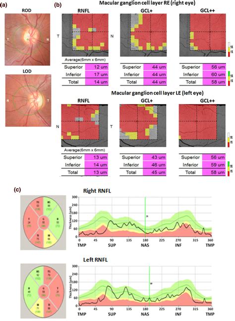 Ophthalmological Finding Using 3d Optical Coherence Tomography Oct