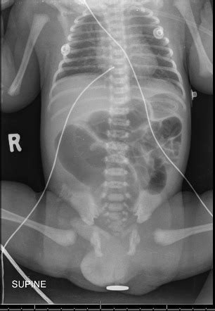 Imperforate Anus Radiology Case Radiopaedia Org