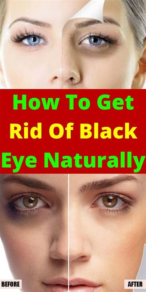 How To Get Rid Of Black Eye Naturally Eye Black Skin Best Skin Care