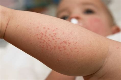 What To Know About Heat Rash In Babies Arabia Day