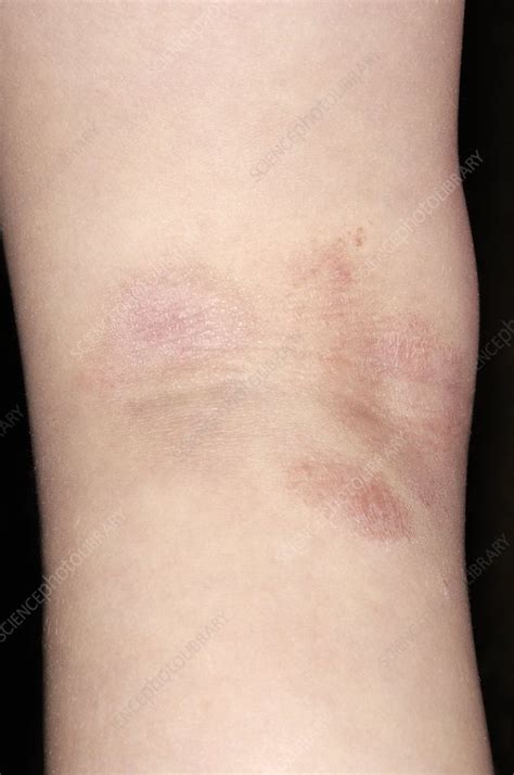 Atopic Eczema Stock Image C0024730 Science Photo Library