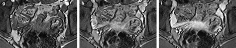 Congenital Abnormalities Of The Mullerian Ducts Radiology Key