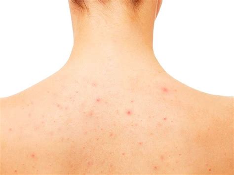 How to Get Rid of Back Acne: 8 Tips and Products From a ...
