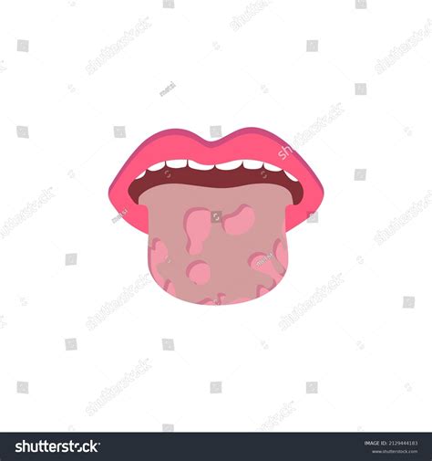 Glossitis Oral Thrush Candidiasis On Tongue Stock Vector Royalty Free
