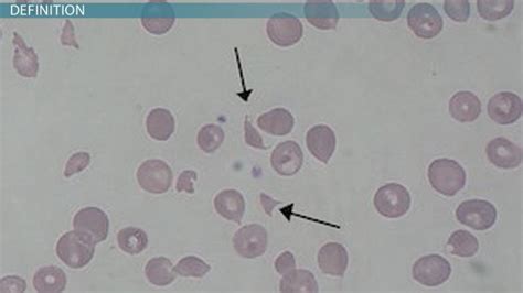 What Is Hemolysis Definition Causes And Symptoms Video And Lesson