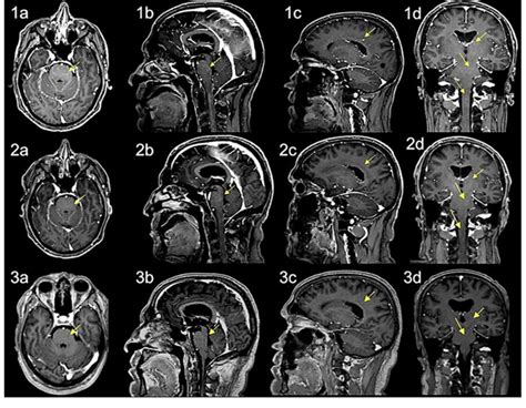 Brain Mri Scan At Admission After 1 Week Of Steroid Therapy And After