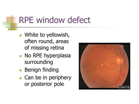 Ppt Vitreous And Peripheral Retinal Anomalies Powerpoint Presentation