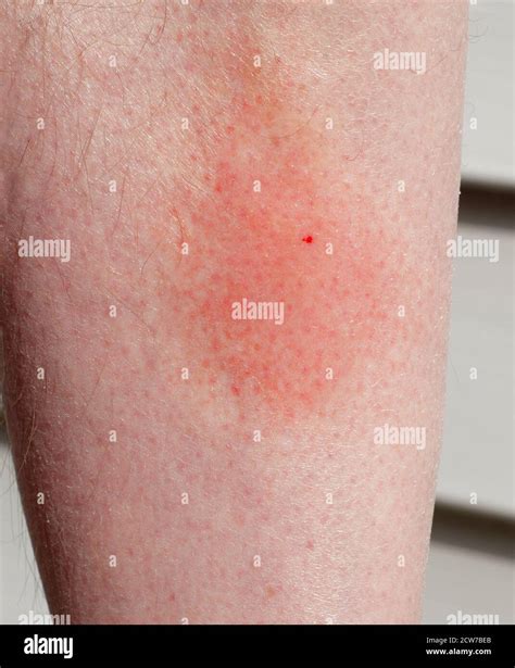 Bee Sting Skin Hi Res Stock Photography And Images Alamy