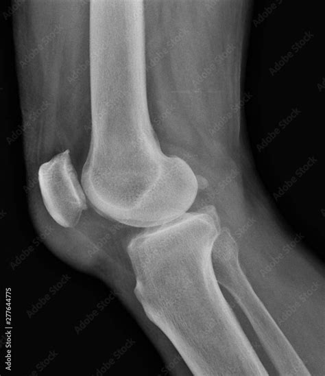 Film X Ray Knee Of Osteoarthritis Knee Patient Stock Photo Adobe Stock