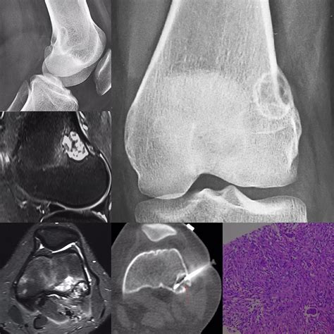 Normal Radiographic Anatomy Of The Knee 2 Distal Femo