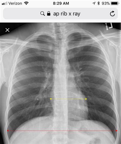 Ap Ribs Used To Visualize Posterior Ribs X Ray Visual Radiology