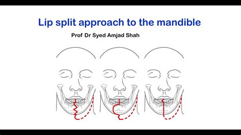 Lip Split Approach To The Mandible Oral And Maxillofacial Surgery Syed Amjad Shah Youtube