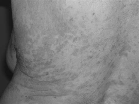 Many Hyperpigmented Macules On The Trunk In Patient With Hypothyroidism