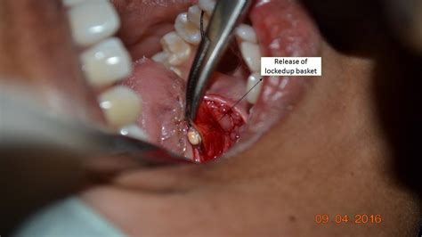 Sialendoscopy Combined Approach For Salivary Stone Removal Mcv