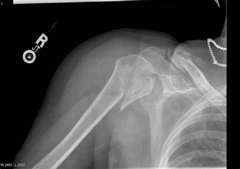 Right Shoulder Fracture Radrounds Radiology Network