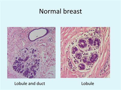 Ppt Breast Pathology Powerpoint Presentation Free Download Id486107