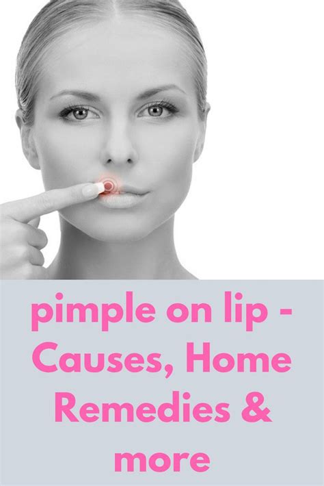 Easy Skin Care Tips You Should Follow Home Remedies For Pimples