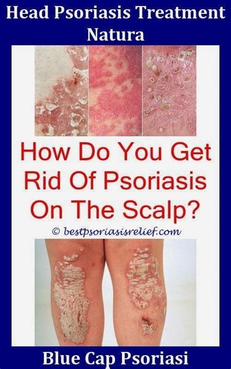 Guttate Psoriasis Scars