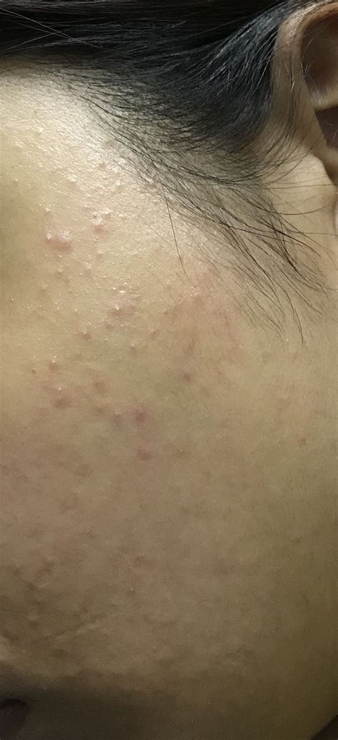 Sudden Tiny Bumps On Face General Acne Discussion