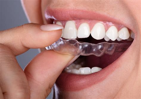 Brookline Dentist Suggests Night Guards To Reduce Dental Trauma