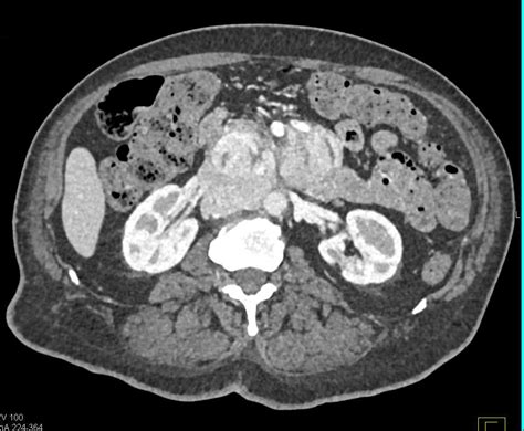 Pancreatic Neuroendocrine Tumor Pancreas Case Studies Ctisus Ct