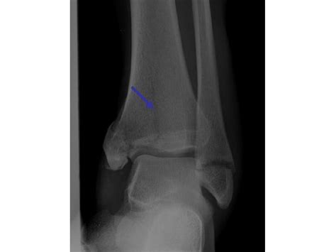 Ankle X Ray Interpretation Dont Forget The Bubbles