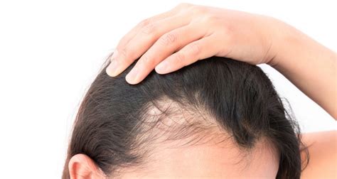 Pulling Your Hair Back Too Tight Causing Hair Loss Traction Alopecia