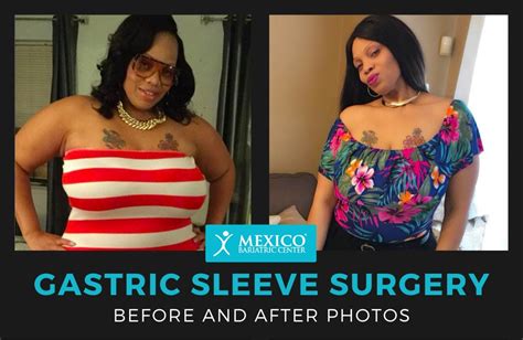 Gastric Sleeve Before And After Archives Mexico Bariatric Center