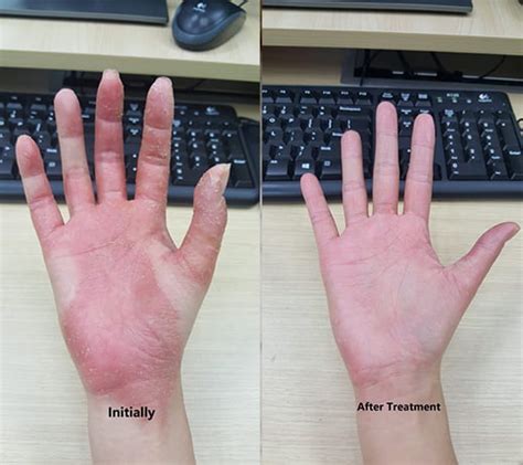 Pompholyx Eczema Treatment With Chinese Medicine Chinese Doc Singapore