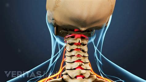 Cervical Radiculopathy Definition Back Pain And Neck Pain Medical