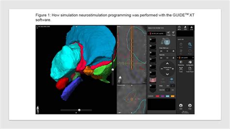 Neuroimaging Software Assisted Deep Brain Stimulation Dbs Programming