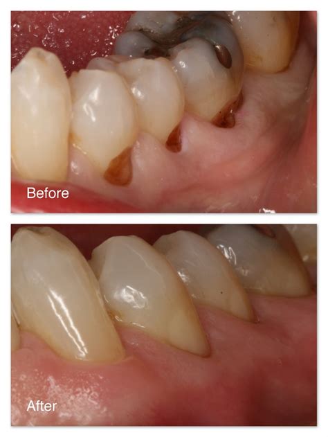 Restoration Of Worn Teeth Dr Jack M Hosner Dds