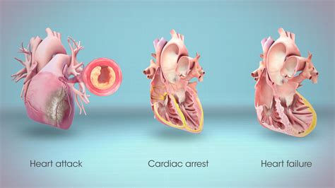 Difference Between Heart Attack And Congestive Heart Failure Doctorvisit