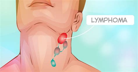 9 Warning Signs Of Lymphoma To Pay Attention To