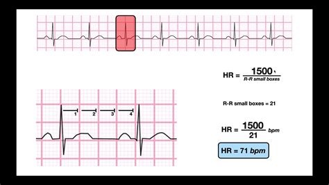 How To Calculate Heart Rate From Ecg With Irregular Rhythm All